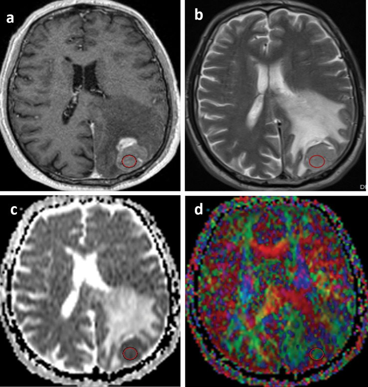 Diffusion Tensor Imaging Can Discriminate the Primary Cell Type of Intracranial Metastases for Patients with Lung Cancer.