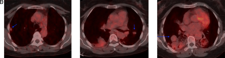 Coexistence of Multiple Pulmonary Sclerosing Pneumocytoma and Scleroderma-Rheumatoid Arthritis Overlap Syndrome: A Case Report.