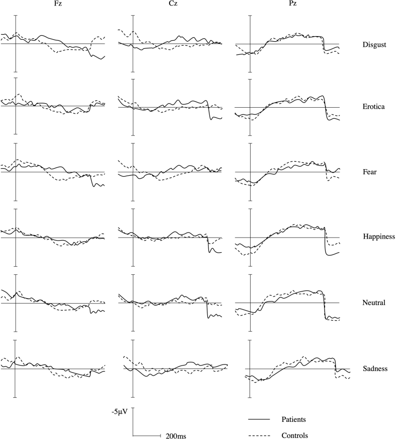 Cerebral processing of emotions in phantom eye pain patients: An event related potential study