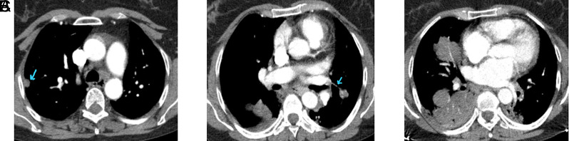 Coexistence of Multiple Pulmonary Sclerosing Pneumocytoma and Scleroderma-Rheumatoid Arthritis Overlap Syndrome: A Case Report.