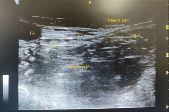 Comparison of Pericapsular Nerve Group Block with Fascia Iliaca Compartment Block in Adult Patients Undergoing Hip Surgeries: A Double-Blinded Randomized Control Study.