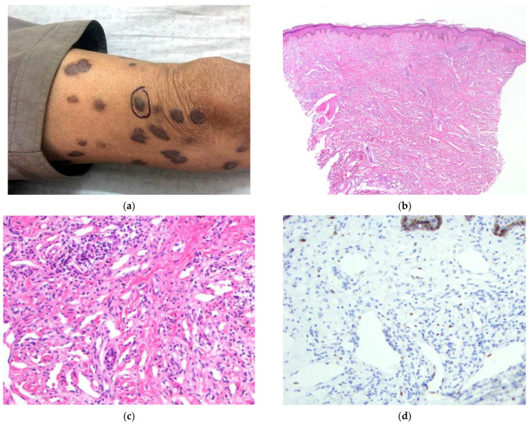 Kaposi Sarcoma in Afghanistan: A Case Series from a Tertiary Referral Center.