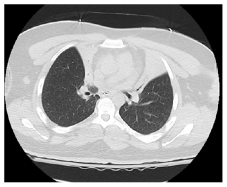 Bilateral Upper Lobe Collapse Secondary to Vaping.