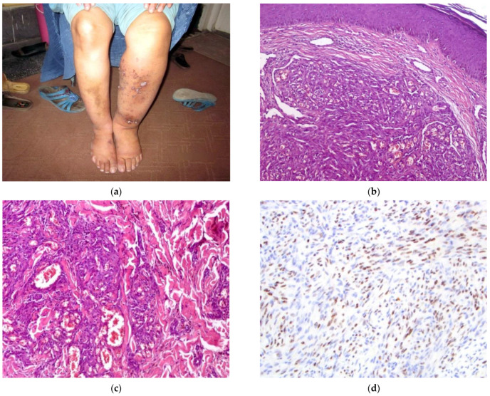 Kaposi Sarcoma in Afghanistan: A Case Series from a Tertiary Referral Center.