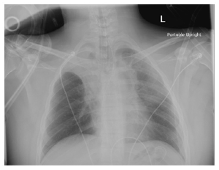 Bilateral Upper Lobe Collapse Secondary to Vaping.