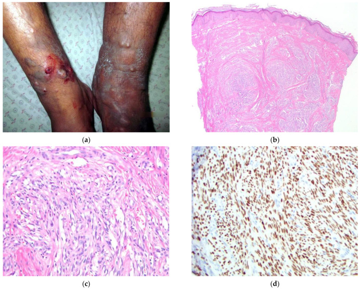 Kaposi Sarcoma in Afghanistan: A Case Series from a Tertiary Referral Center.