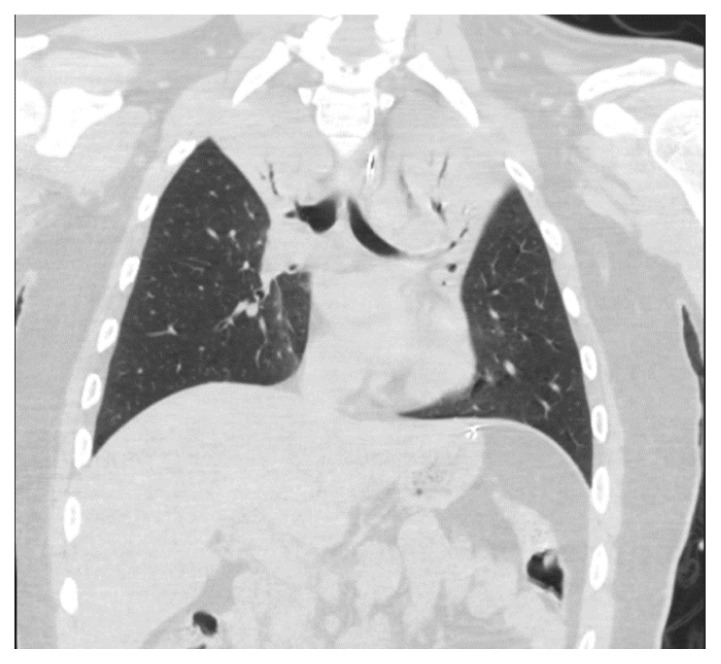 Bilateral Upper Lobe Collapse Secondary to Vaping.