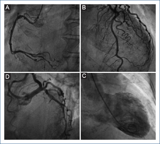 Cardiogenic shock as the initial manifestation of takotsubo syndrome.