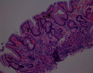 Gastric Pseudomelanosis: An Uncommon Finding.