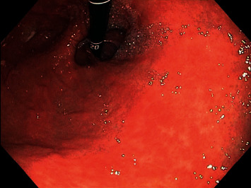 Gastric Pseudomelanosis: An Uncommon Finding.