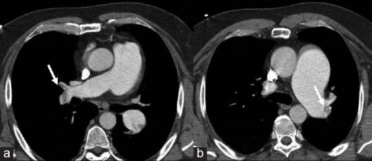 Paradoxical Pulmonary Embolism in a Patient with Bilateral Renal Infarction: The Role of Contrast-enhanced Ultrasound Imaging.