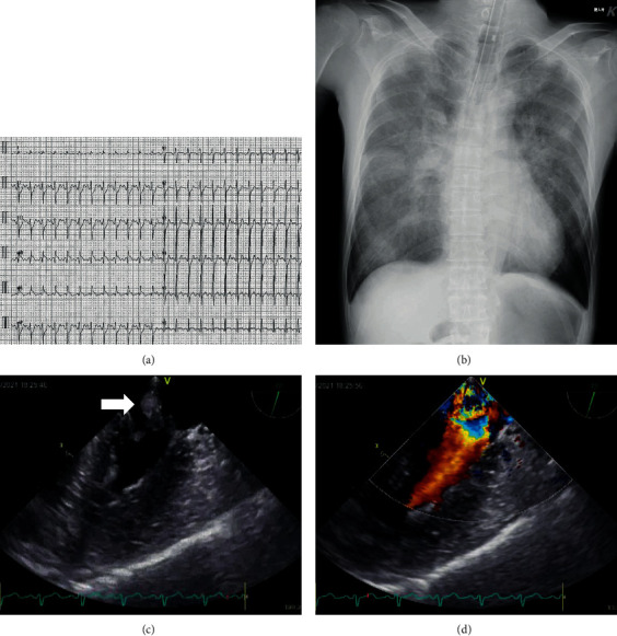 Anterior Papillary Muscle Rupture due to Acute Myocardial Microinfarction of the Small High Lateral Branch.