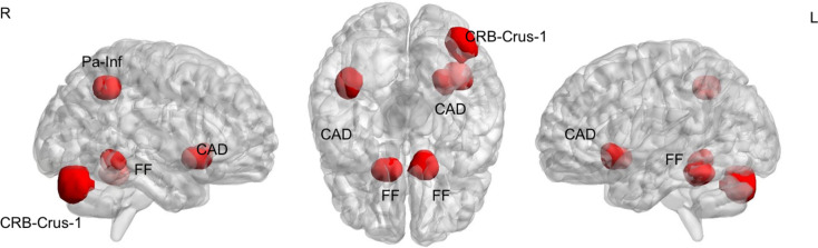 Brain Structural Correlates of Intelligence in Attention Deficit Hyperactivity Disorder (ADHD) Individuals.