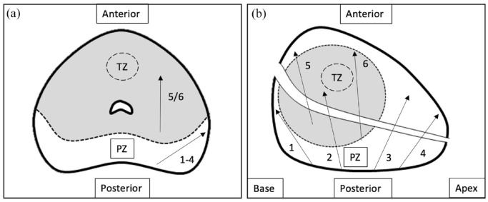 An optimized prostate biopsy strategy in patients with a unilateral lesion on prostate magnetic resonance imaging avoids unnecessary biopsies.