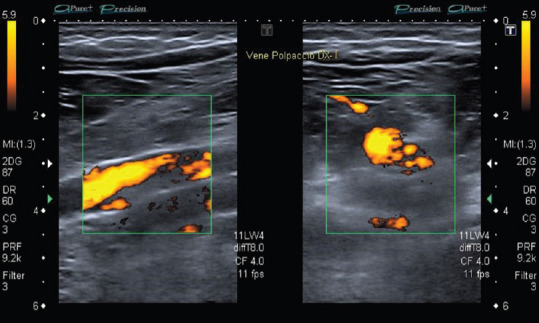 Paradoxical Pulmonary Embolism in a Patient with Bilateral Renal Infarction: The Role of Contrast-enhanced Ultrasound Imaging.