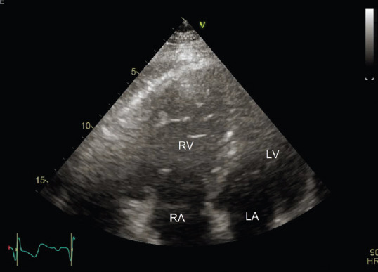 Paradoxical Pulmonary Embolism in a Patient with Bilateral Renal Infarction: The Role of Contrast-enhanced Ultrasound Imaging.