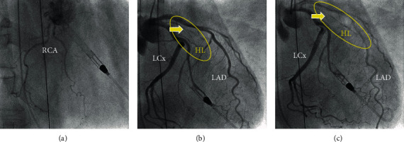 Anterior Papillary Muscle Rupture due to Acute Myocardial Microinfarction of the Small High Lateral Branch.
