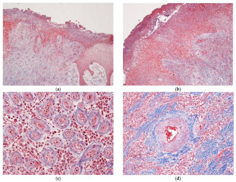 Large Lobular Capillary Hemangioma Associated with Ingrown Toenail: Histopathological Features and Case Report.