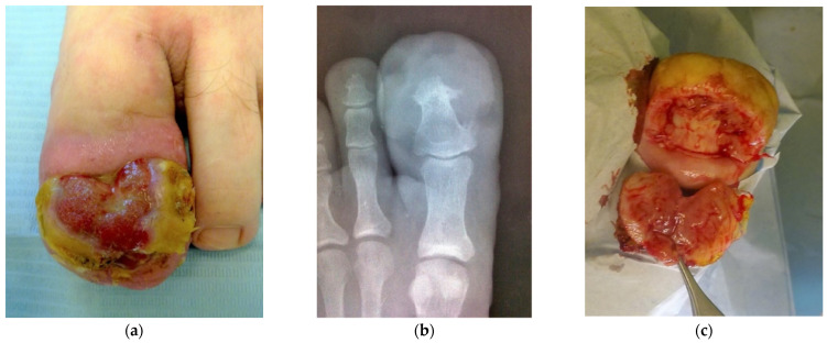 Large Lobular Capillary Hemangioma Associated with Ingrown Toenail: Histopathological Features and Case Report.