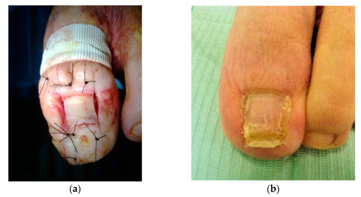 Large Lobular Capillary Hemangioma Associated with Ingrown Toenail: Histopathological Features and Case Report.