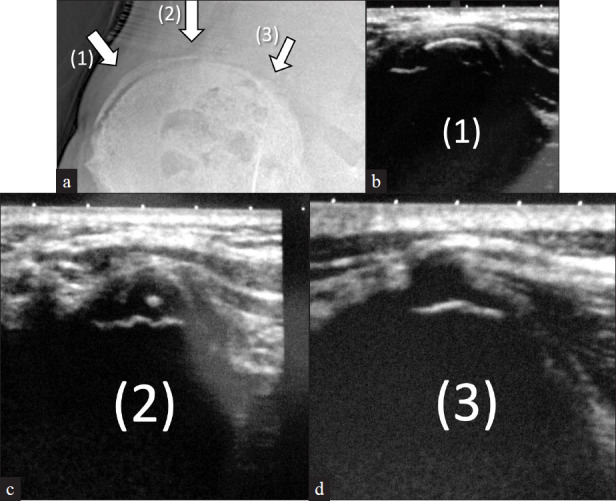 Earlier appearance of Risser sign on ultrasound versus radiograph in adolescent idiopathic scoliosis.