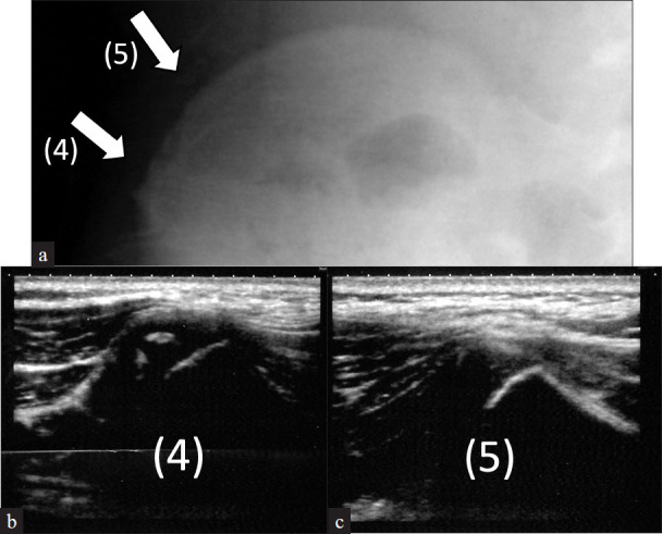 Earlier appearance of Risser sign on ultrasound versus radiograph in adolescent idiopathic scoliosis.