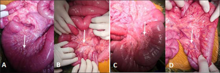 A case report of mesenteric involvement in neurofibromatosis type 1.