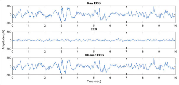 Detection of ADHD From EOG Signals Using Approximate Entropy and Petrosain's Fractal Dimension.