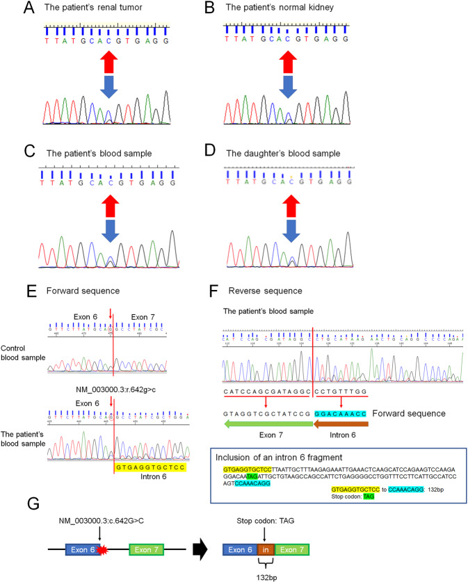 Succinate dehydrogenase B-deficient renal cell carcinoma with a germline variant in a Japanese patient: a case report.