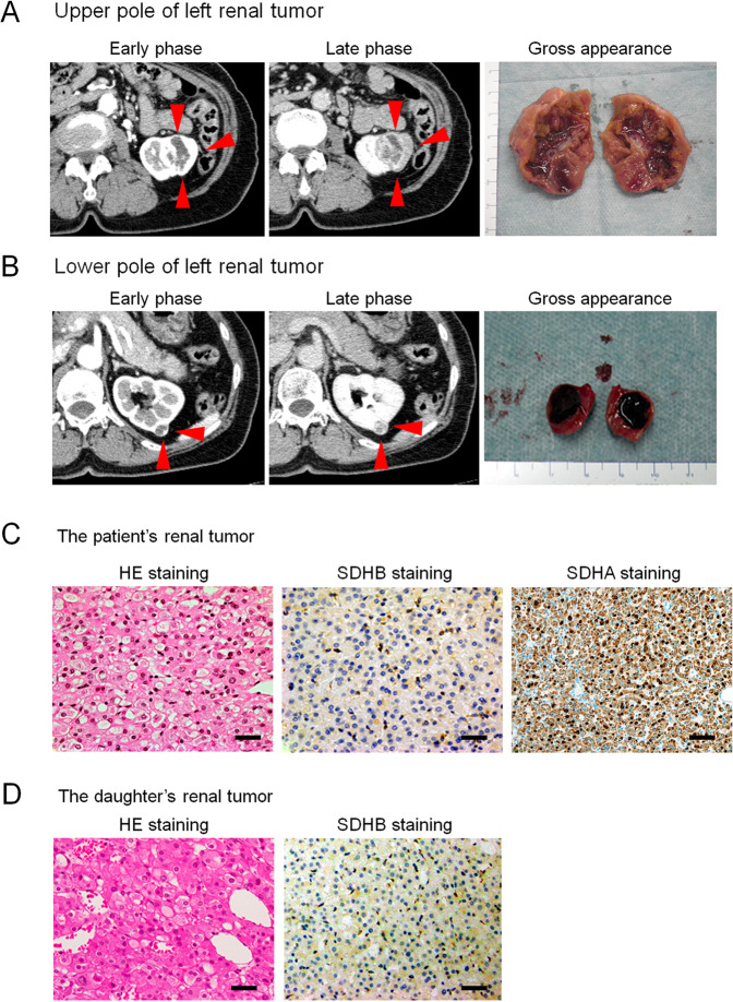 Succinate dehydrogenase B-deficient renal cell carcinoma with a germline variant in a Japanese patient: a case report.