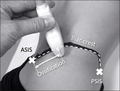 Earlier appearance of Risser sign on ultrasound versus radiograph in adolescent idiopathic scoliosis.