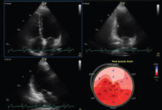 Global Longitudinal Strain in Wellens' Syndrome.