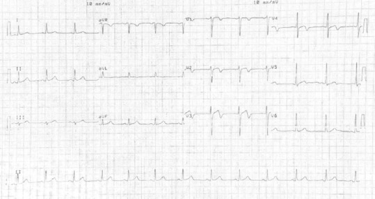 Global Longitudinal Strain in Wellens' Syndrome.