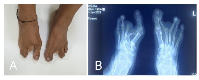 An Unusual Presentation of Bilateral Split Hand-Foot Malformation (SHFM) in Family: A Tale of Two Generations.