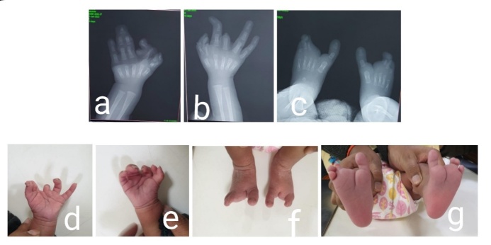 An Unusual Presentation of Bilateral Split Hand-Foot Malformation (SHFM) in Family: A Tale of Two Generations.