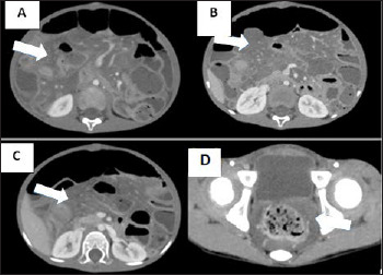 A case report of mesenteric involvement in neurofibromatosis type 1.