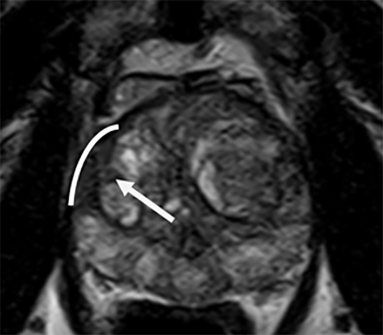 Combining the Tumor Contact Length and Apparent Diffusion Coefficient Better Predicts Extraprostatic Extension of Prostate Cancer with Capsular Abutment: A 3 Tesla MR Imaging Study.