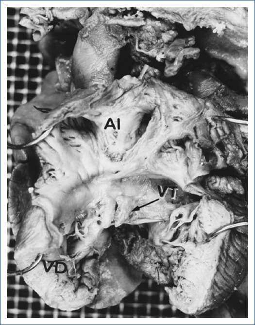 Discordant atrioventricular connections with truncus arteriosus.