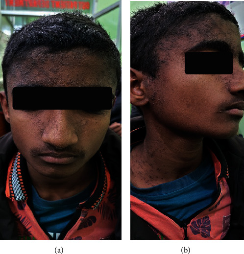 Clinical and Histopathological Findings in a Patient of Darier-White Disease with Acrokertasosis Verruciformis of Hopf.