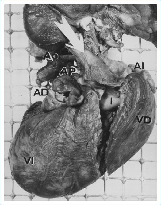 Discordant atrioventricular connections with truncus arteriosus.