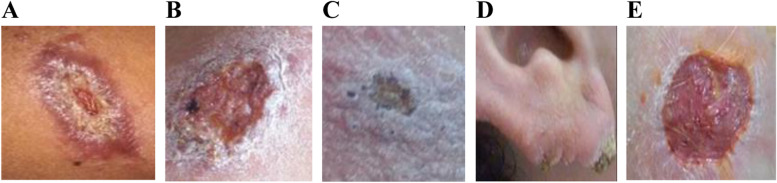 Imported cases of cutaneous leishmaniasis in Cuba, 2017: role of human movement.