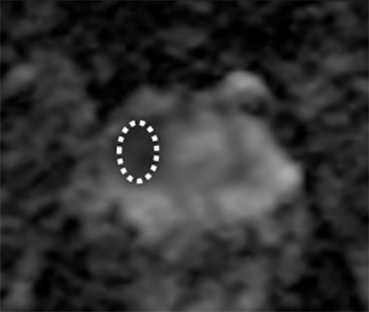 Combining the Tumor Contact Length and Apparent Diffusion Coefficient Better Predicts Extraprostatic Extension of Prostate Cancer with Capsular Abutment: A 3 Tesla MR Imaging Study.