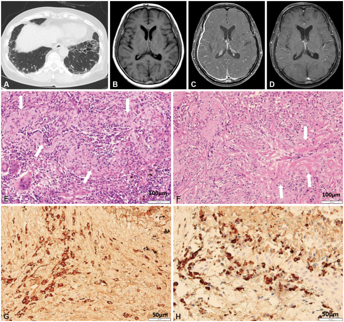 Hypertrophic Pachymeningitis and Interstitial Lung Disease in IgG4-Related Disease.