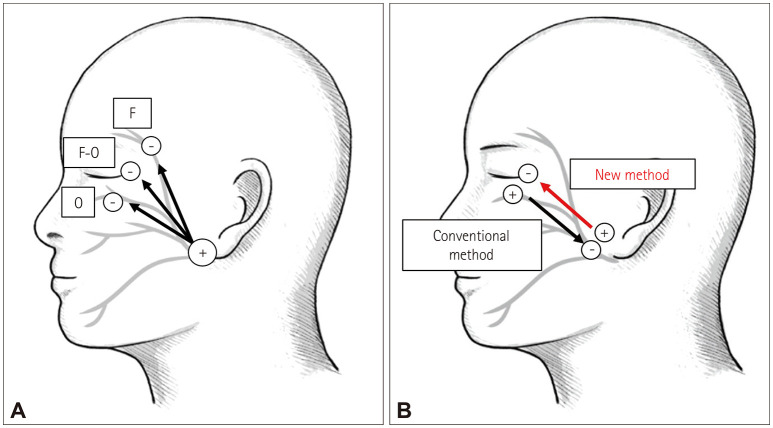 Advances in Intraoperative Neurophysiology During Microvascular Decompression Surgery for Hemifacial Spasm.