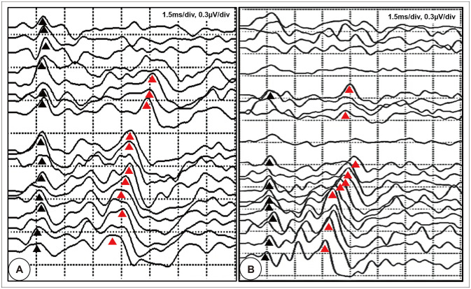 Advances in Intraoperative Neurophysiology During Microvascular Decompression Surgery for Hemifacial Spasm.