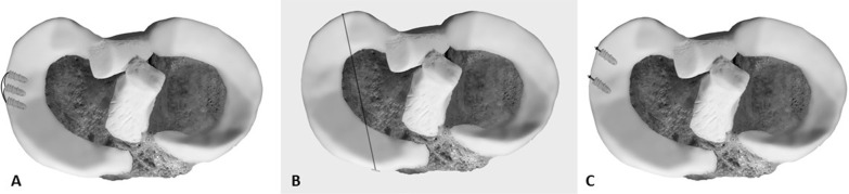 Clinical significance and management of meniscal extrusion in different knee pathologies: a comprehensive review of the literature and treatment algorithm.