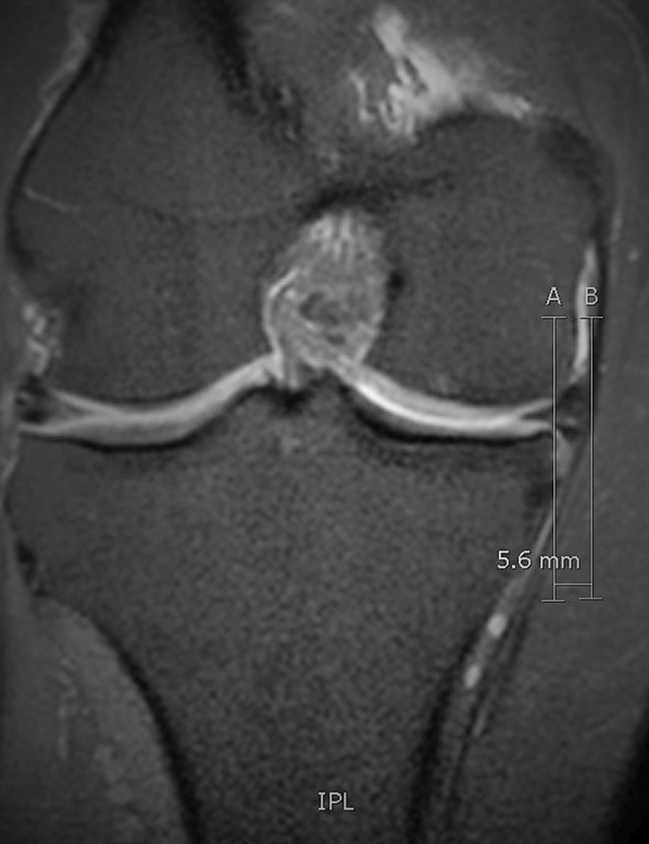 Clinical significance and management of meniscal extrusion in different knee pathologies: a comprehensive review of the literature and treatment algorithm.