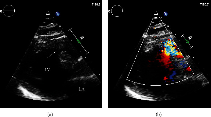 Post-Myocardial Infarction Ventricular Septal Defect Successfully Treated with Impella as Bridge to Cardiac Transplantation.