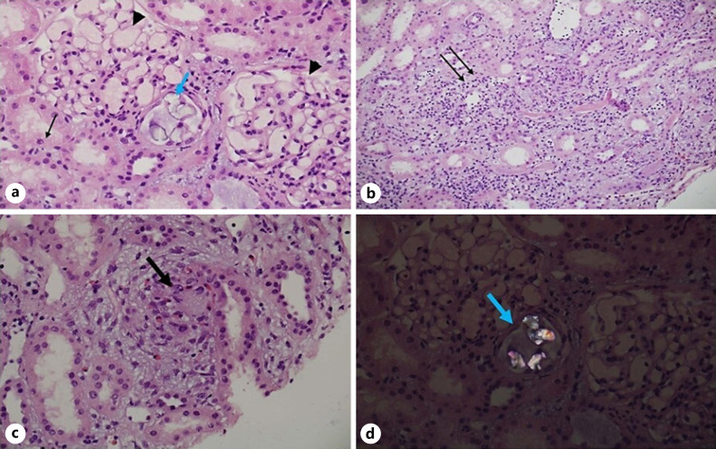 Acute Kidney Injury following Exposure to Formaldehyde-Free Hair-Straightening Products.