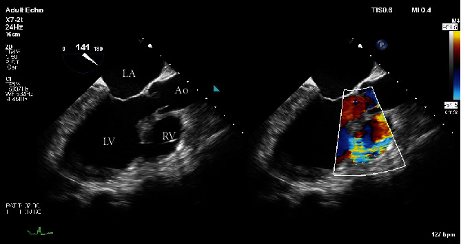 Post-Myocardial Infarction Ventricular Septal Defect Successfully Treated with Impella as Bridge to Cardiac Transplantation.